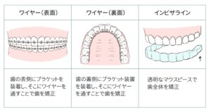 出っ歯矯正の費用と期間 費用相場や内訳 支払い方法まとめ キレイを叶える歯科矯正ロードマップ