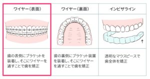 出っ歯矯正の費用と期間 費用相場や内訳 支払い方法まとめ キレイを叶える歯科矯正ロードマップ