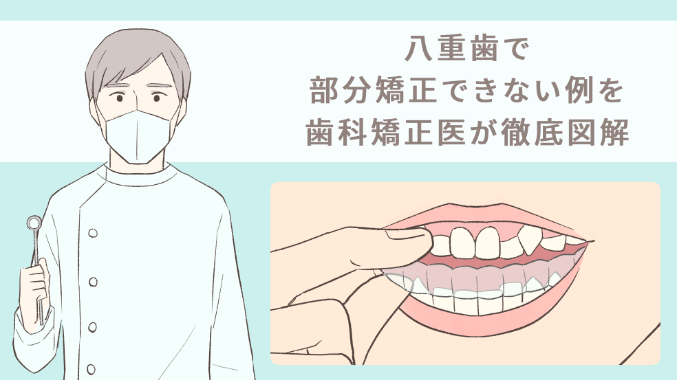 八重歯で部分矯正できない例を歯科矯正医が徹底図解 キレイを叶える歯科矯正ロードマップ