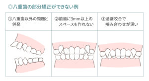 八重歯で部分矯正できない3つの例を図で示しています