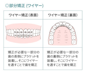 八重歯のワイヤー矯正の部分矯正の表