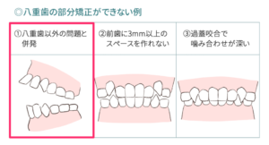 八重歯以外の問題と併発している場合の図