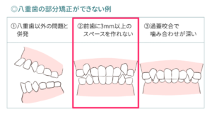 3mm以上のスペースが必要な八重歯の場合の図