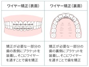 すきっ歯の部分矯正の図解１