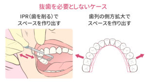 八重歯を抜くべきか を判断するために知っておくべき症例の特徴 キレイを叶える歯科矯正ロードマップ