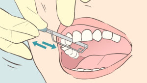 インビザライン矯正で抜歯が必要な症例と抜歯不要な症例 | キレイを叶える歯科矯正ロードマップ