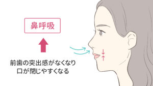 八重歯によるほうれい線は矯正治療で消える理由を徹底図解 キレイを叶える歯科矯正ロードマップ