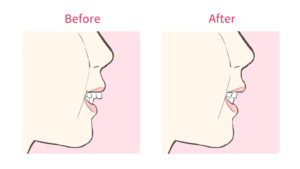 出っ歯矯正時の横顔の変化と理想の横顔を歯科矯正医に伝える5つのポイント キレイを叶える歯科矯正ロードマップ