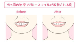 出っ歯矯正時の横顔の変化と理想の横顔を歯科矯正医に伝える5つのポイント キレイを叶える歯科矯正ロードマップ