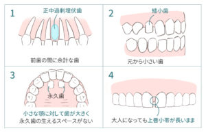 すきっ歯の先天的な原因の図解