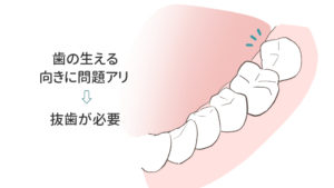 歯の向きに問題がある場合に抜歯が必要になるケース