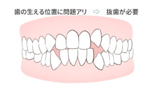 歯の位置に問題がある場合で抜歯が必要になるケース