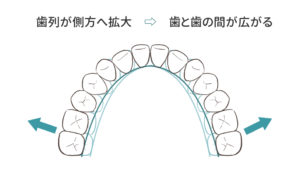 抜歯せずに側方拡大することで歯の隙間を作って歯列矯正を可能にしているイメージ図①