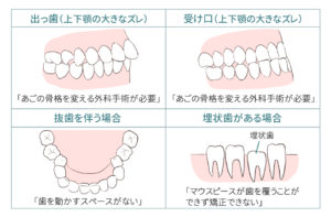 インビザラインのデメリット：歯並びや骨格によっては使用できない4つのパターンの図