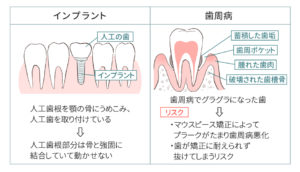 インビザラインのデメリット：歯周病やインプラントの場合は使用できない例の図