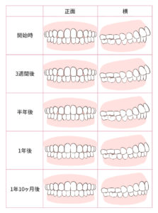 31歳女性会社員のインビザライン治療体験談 1年10ヶ月で矯正完了 キレイを叶える歯科矯正ロードマップ